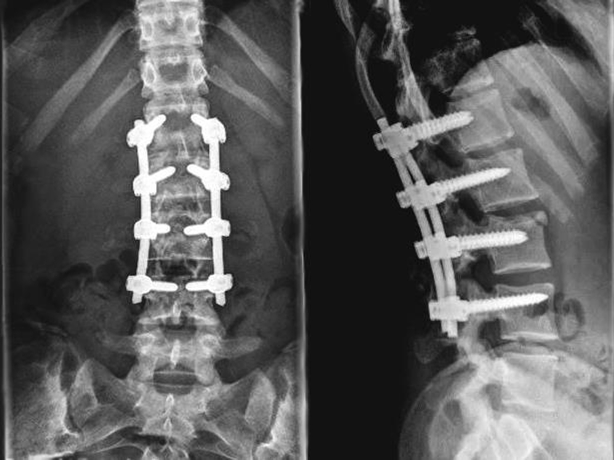 x-ray of human spine with four screws and bolts, two angles